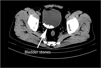 Frontiers Sexual Dysfunction in Patients With Urinary Bladder